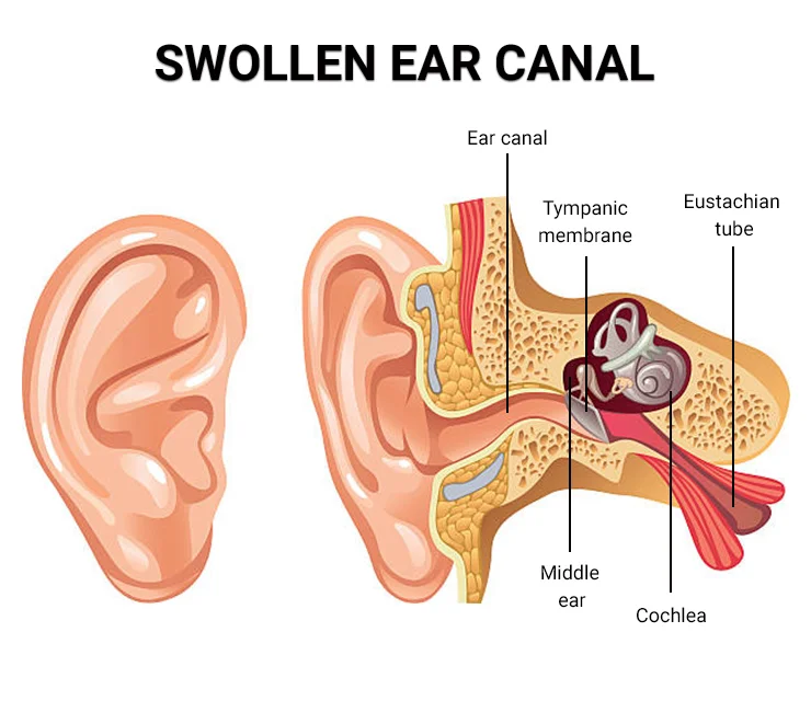 What Helps an Ear Infection: Effective Treatments and Home Remedies