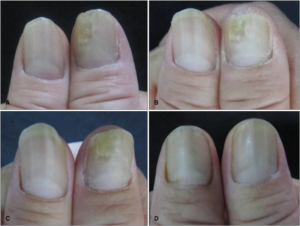 Before and After Toenail Fungus Treatment Real Pictures of Toenail Fungus and Effective Solutions