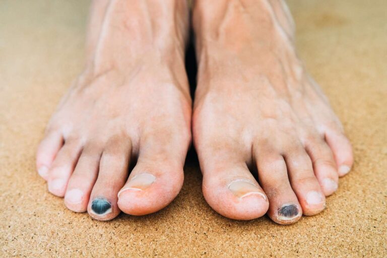 How to Get Rid of Black Toenails