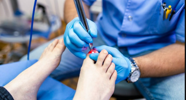 Does Bleach Kill Fungal Nail?