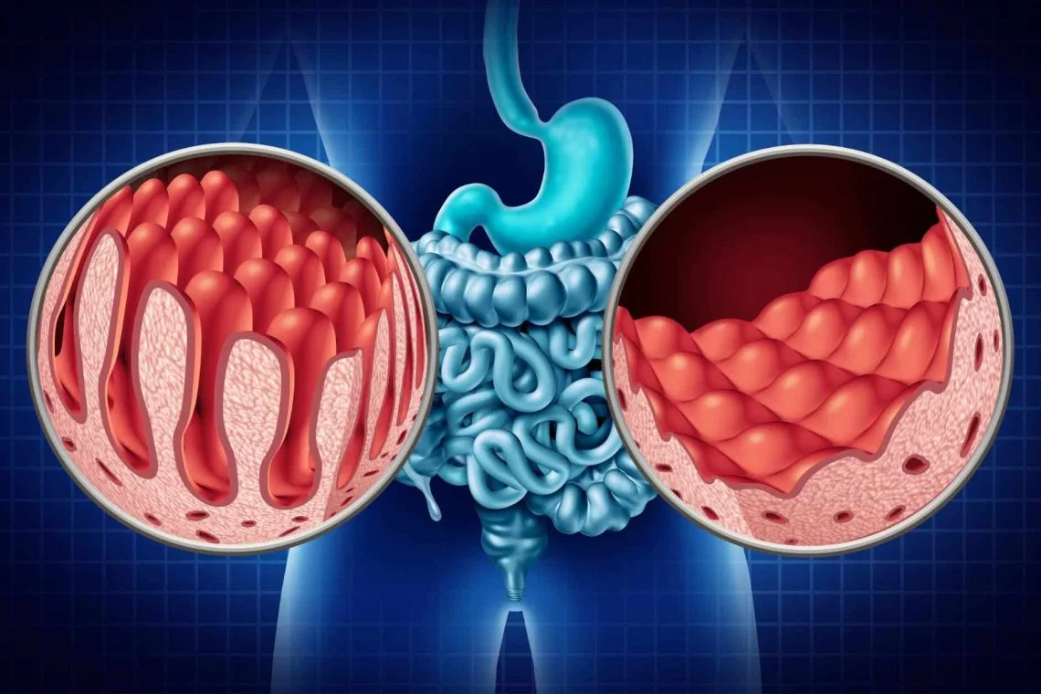 Understanding Celiac Disease