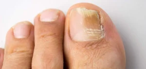 What Kills Toenail Fungus Instantly