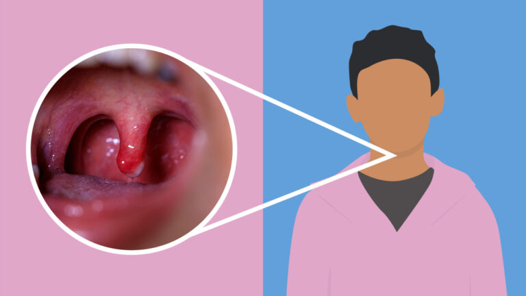 Bad Sore Throat No Fever: Causes, Symptoms, and Treatments