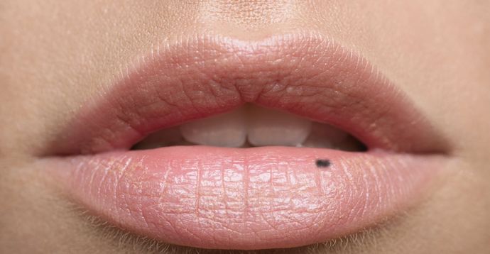 Understanding the Black Dot on Lip: Causes, Treatments, and Prevention