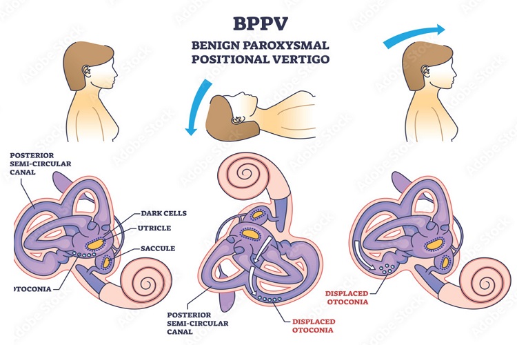 BPPV Treatment: Comprehensive Guide to Managing Benign Paroxysmal Positional Vertigo