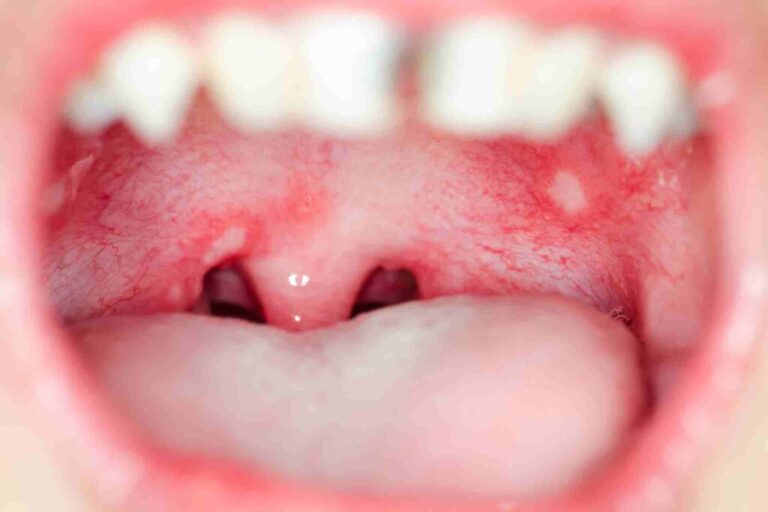 What causes a bump on the roof of the mouth?