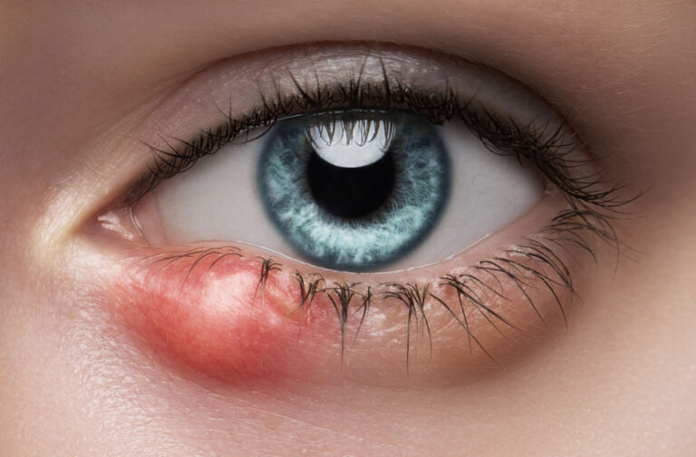 Comprehensive Guide to Chalazion Medication: Effective Treatments and Remedies