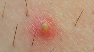 cyst