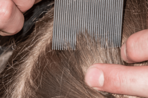 dandruff on lice comb