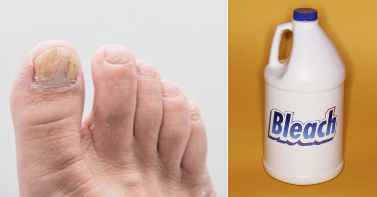 Does Bleach Kill Toenail Fungus? Understanding the Treatment Options