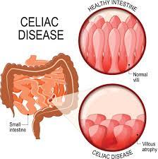 Understanding Celiac Disease: Causes, Symptoms, and Management