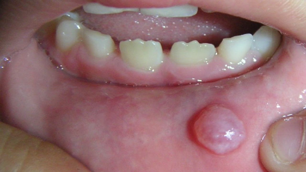 Mucocele Treatment: Effective Methods for Managing and Healing Mucoceles