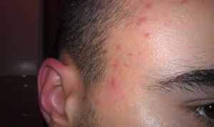 stress rash on forehead