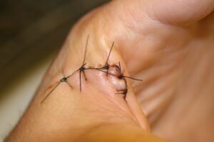 suture removal