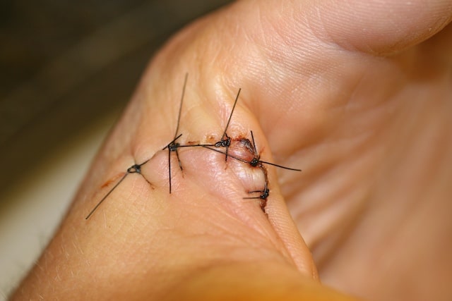 Understanding Suture Removal: A Comprehensive Guide