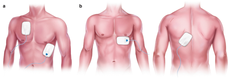 Transcutaneous Pacing: A Comprehensive Guide