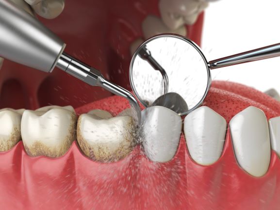 How to Remove Plaque from Teeth at Home: A Comprehensive Guide