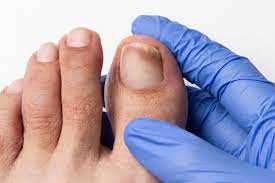 what kills toenail fungus instantly