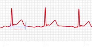 Understanding the Regular QT Interval: Importance, Measurement, and Implications