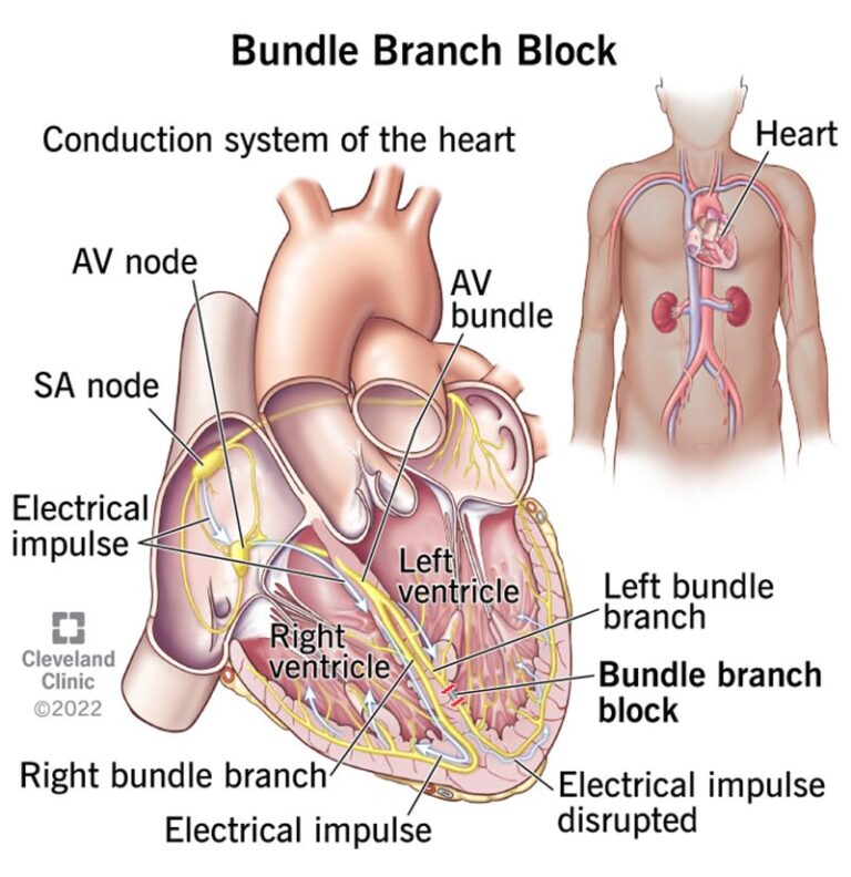 Understanding RBBB (Right Bundle Branch Block) – Simple Guide for Everyone