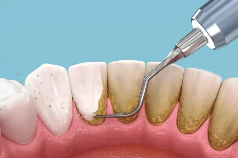 How to Remove Plaque from Teeth at Home: A Step-by-Step Guide