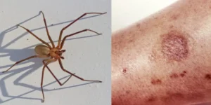 Images of Spider Bites: Understanding and Identifying Spider Bites