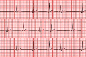 Understanding PAC EKG: A Comprehensive Guide