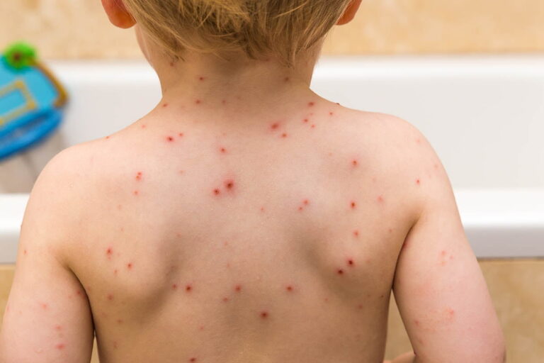 Understanding Chicken Pox: Causes, Symptoms, Treatment, and Prevention