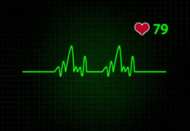 Understanding Atrial Flutter ECG: Easy Guide to Heart Rhythms