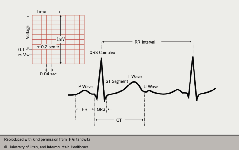 Understanding the Normal QRS Complex