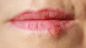 Lip Sores Pictures: Understanding Causes, Symptoms, and Treatments