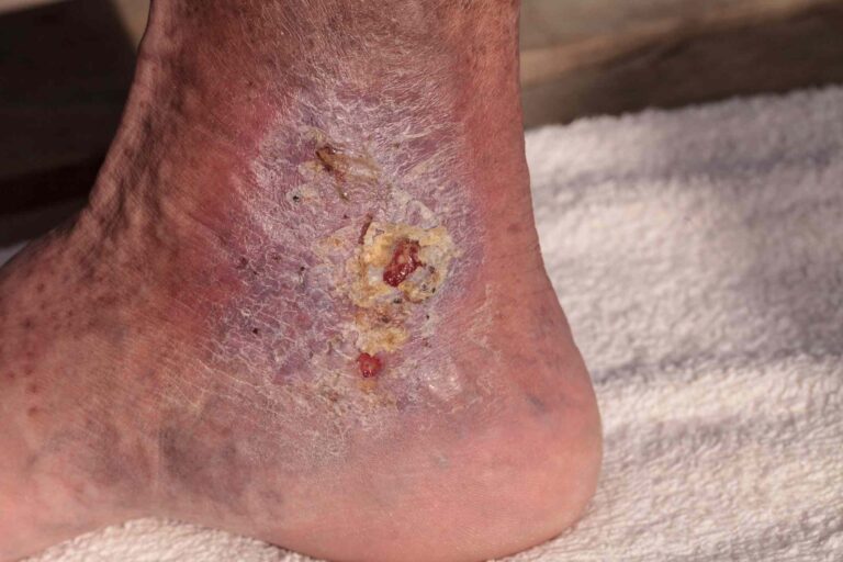 Understanding Cellulitis: Causes, Symptoms, and Treatment