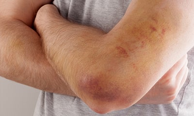 Understanding Hematoma: Causes, Symptoms, and Treatment