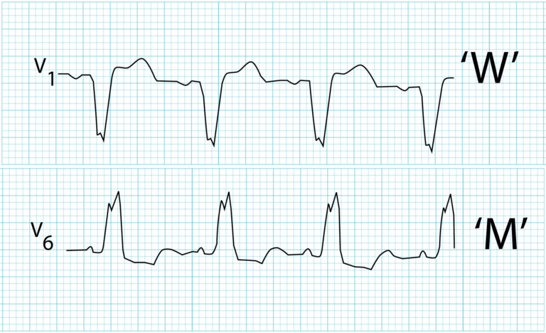 Understanding Left Bundle Branch Block ECG