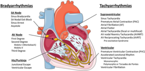 Understanding Wenckebach: An Insight into the Cardiac Conduction Abnormality