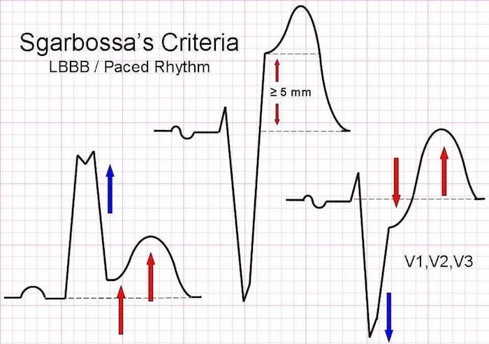 Understanding the Sgarbossa Criteria: A Simple Guide