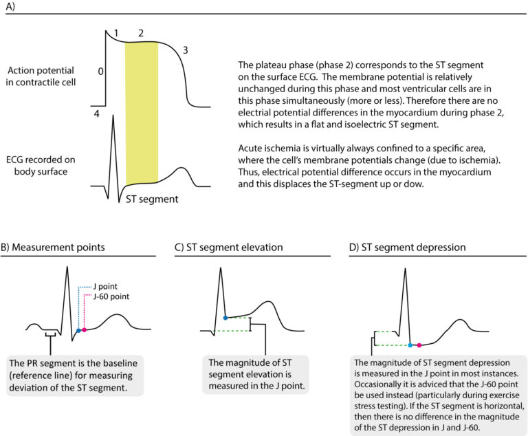 Understanding Raised ST Segment: Causes, Diagnosis, and Treatment