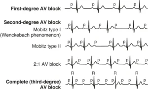 Understanding 2nd Degree Heart Block Type 2: A Comprehensive Guide