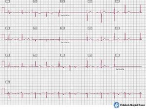 Understanding Second Degree Heart Block Type 2: A Comprehensive Guide