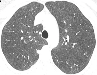 Acute Interstitial Pneumonitis (IBCC): Understanding the Condition