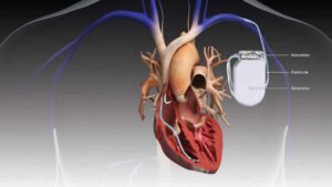 Understanding AICD: An In-depth Guide to Apoptosis Inducing Factor