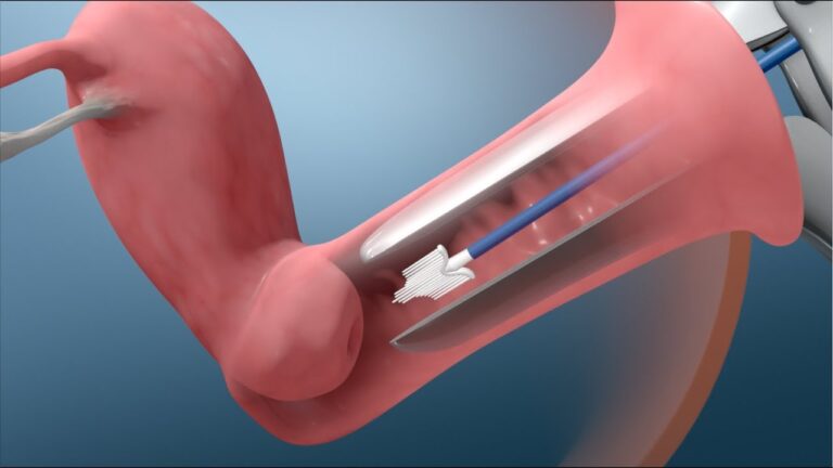 What is Pap Screening? Understanding the Basics