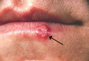 Herpes Photos in Different Stages: Understanding the Condition