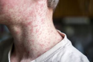 Understanding Mono Rash: Causes, Symptoms, and Treatment