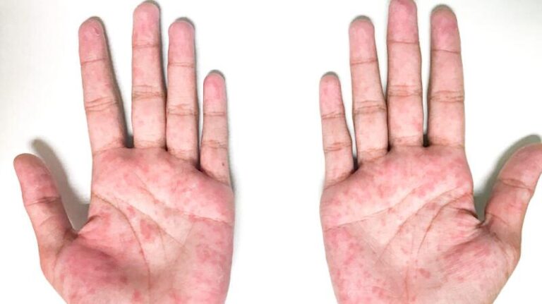 Understanding Erythema: Causes, Symptoms, and Treatments