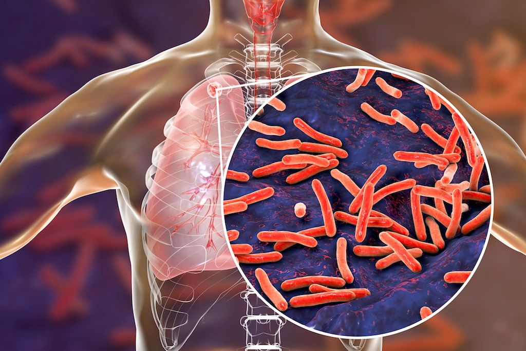 Understanding Tuberculosis: What You Need to Know