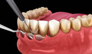 Dental Crowns in Treating Gingivitis - How Do They Help