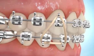 What is The Purpose Of Orthodontic Elastics in Braces?