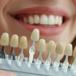 Dental Bonding for a Beautiful Smile: The Art of Aesthetic Perfection