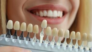 Dental Bonding for a Beautiful Smile: The Art of Aesthetic Perfection